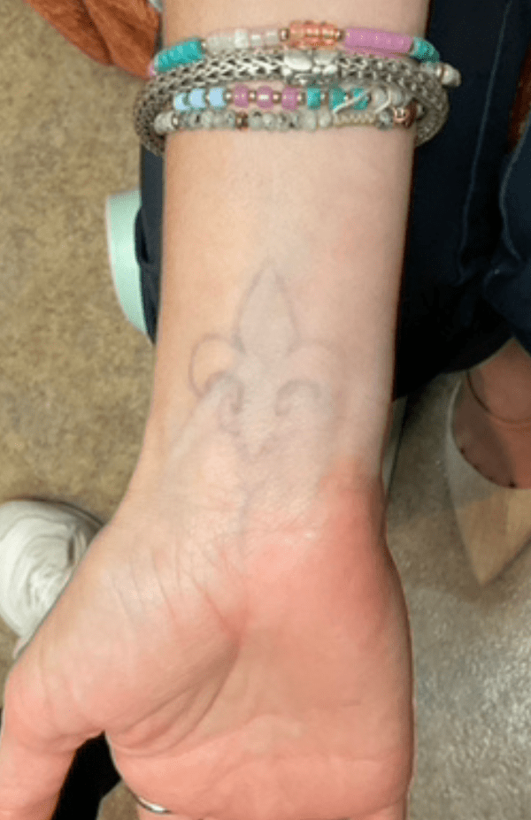 Laser Tattoo Removal Patient Photo - Case 16101 - before view-