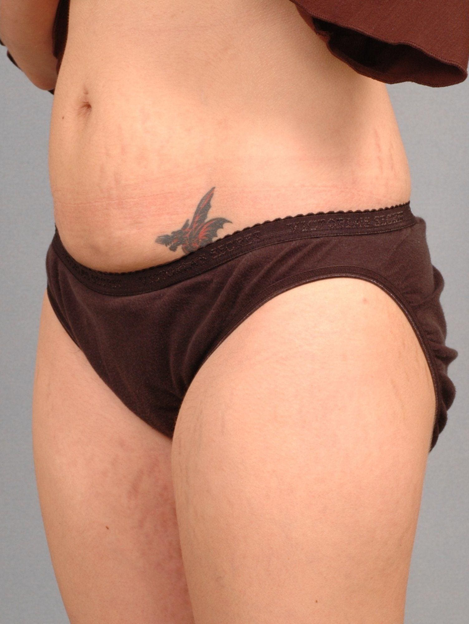 Laser Skin Treatments Patient Photo - Case 16105 - after view-1