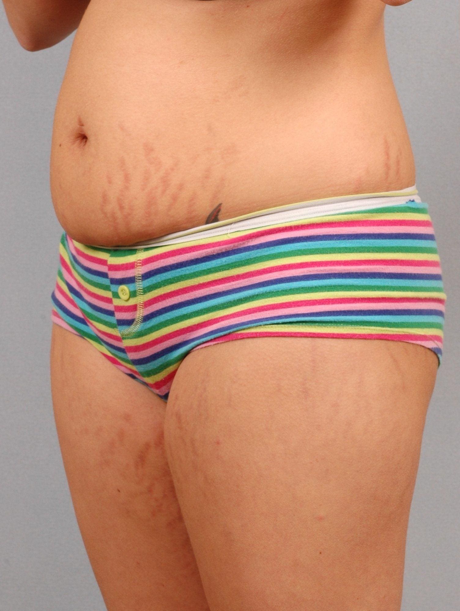Laser Skin Treatments Patient Photo - Case 16105 - before view-1