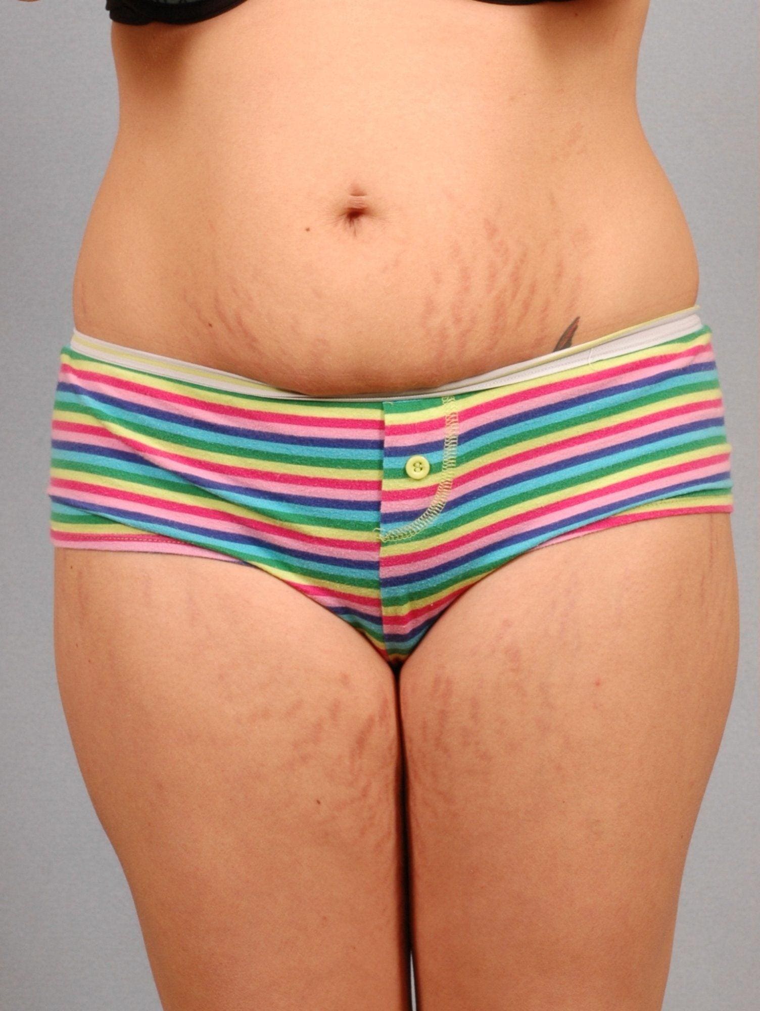 Laser Skin Treatments Patient Photo - Case 16105 - before view-