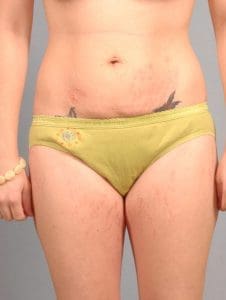 Laser Skin Treatments - Case 16105 - After