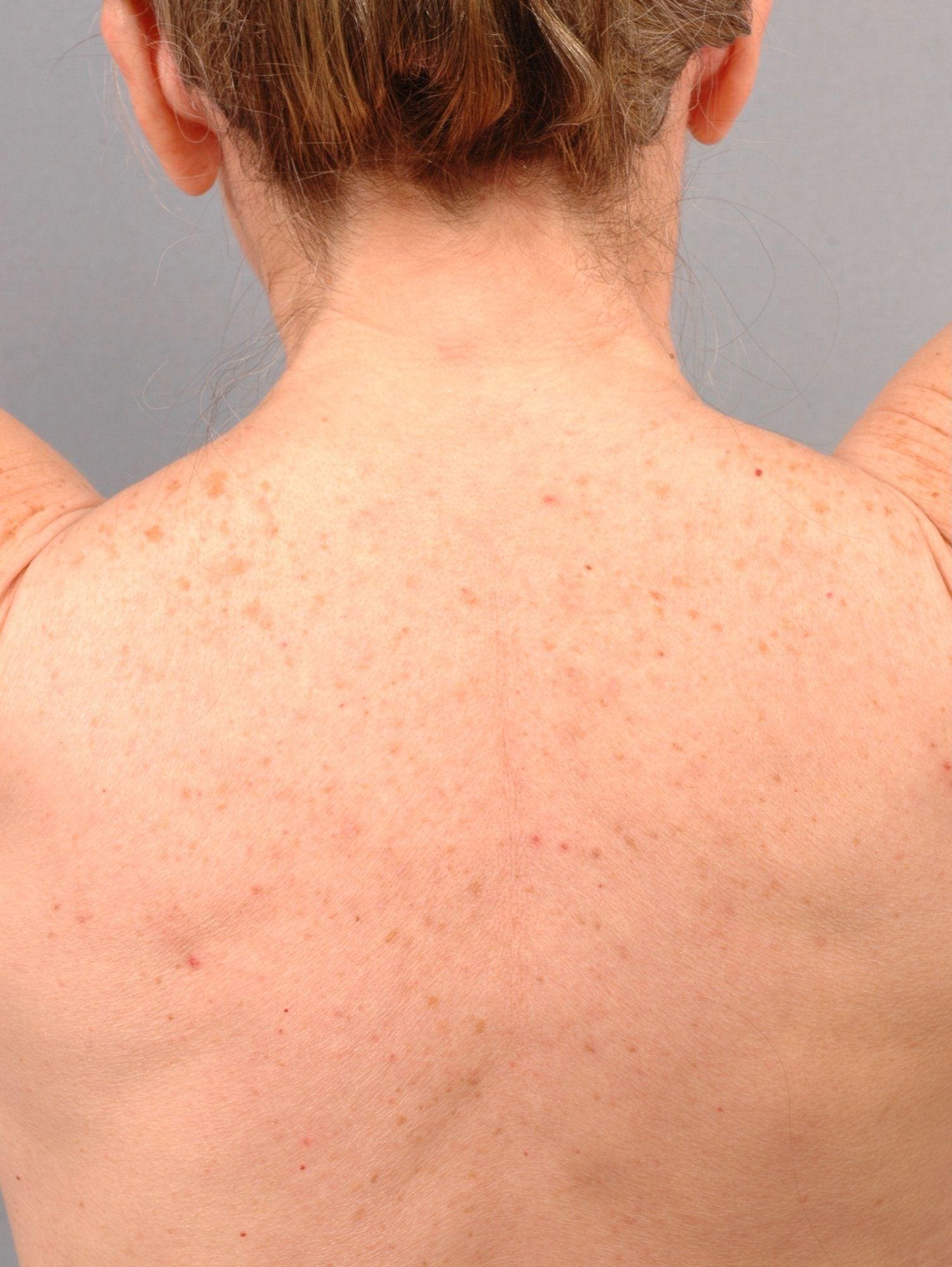 Laser Skin Treatments Patient Photo - Case 16111 - before view-2