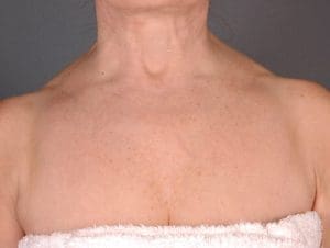 Laser Skin Treatments - Case 16111 - Before