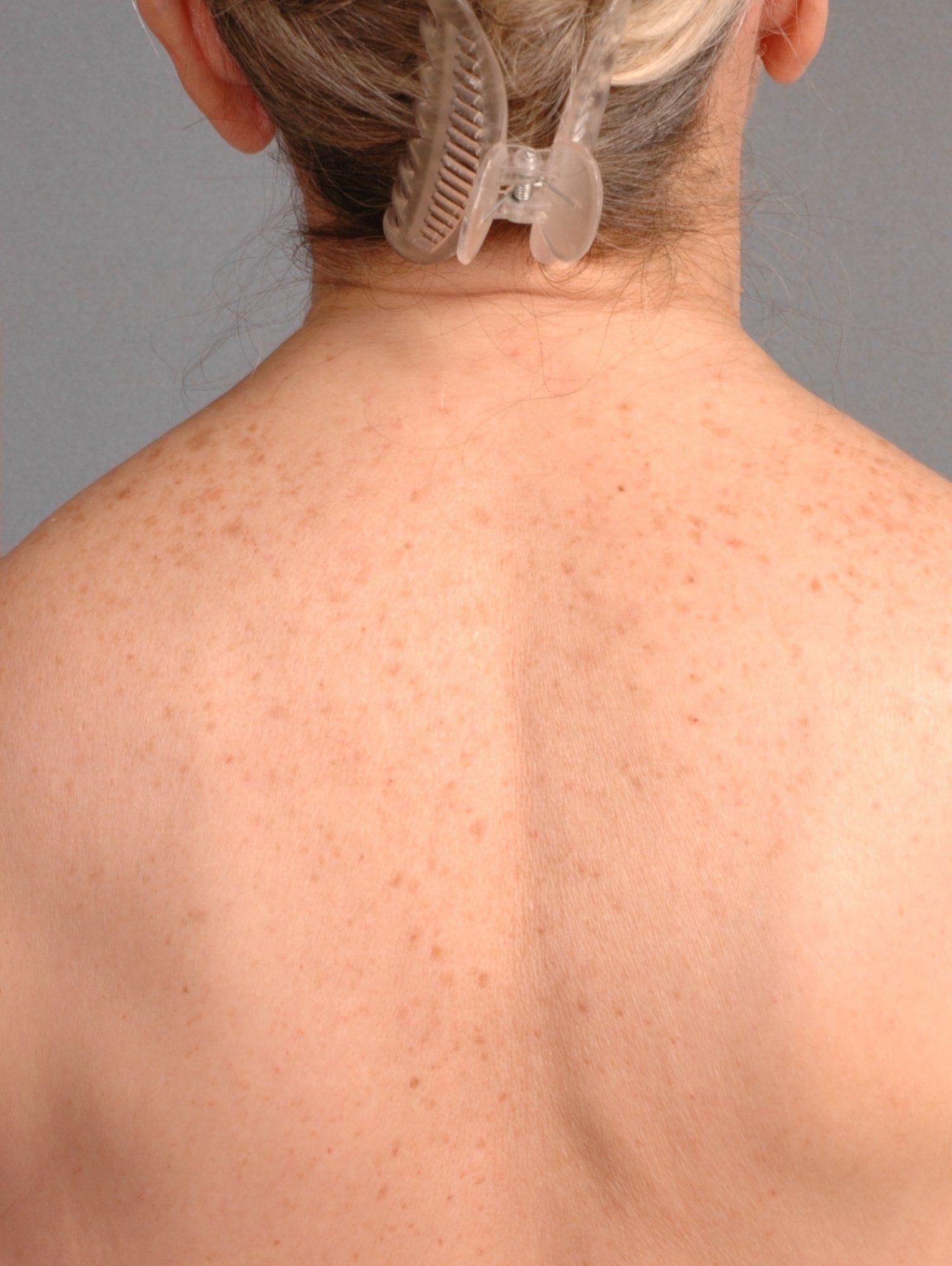 Laser Skin Treatments Patient Photo - Case 16111 - after view-2