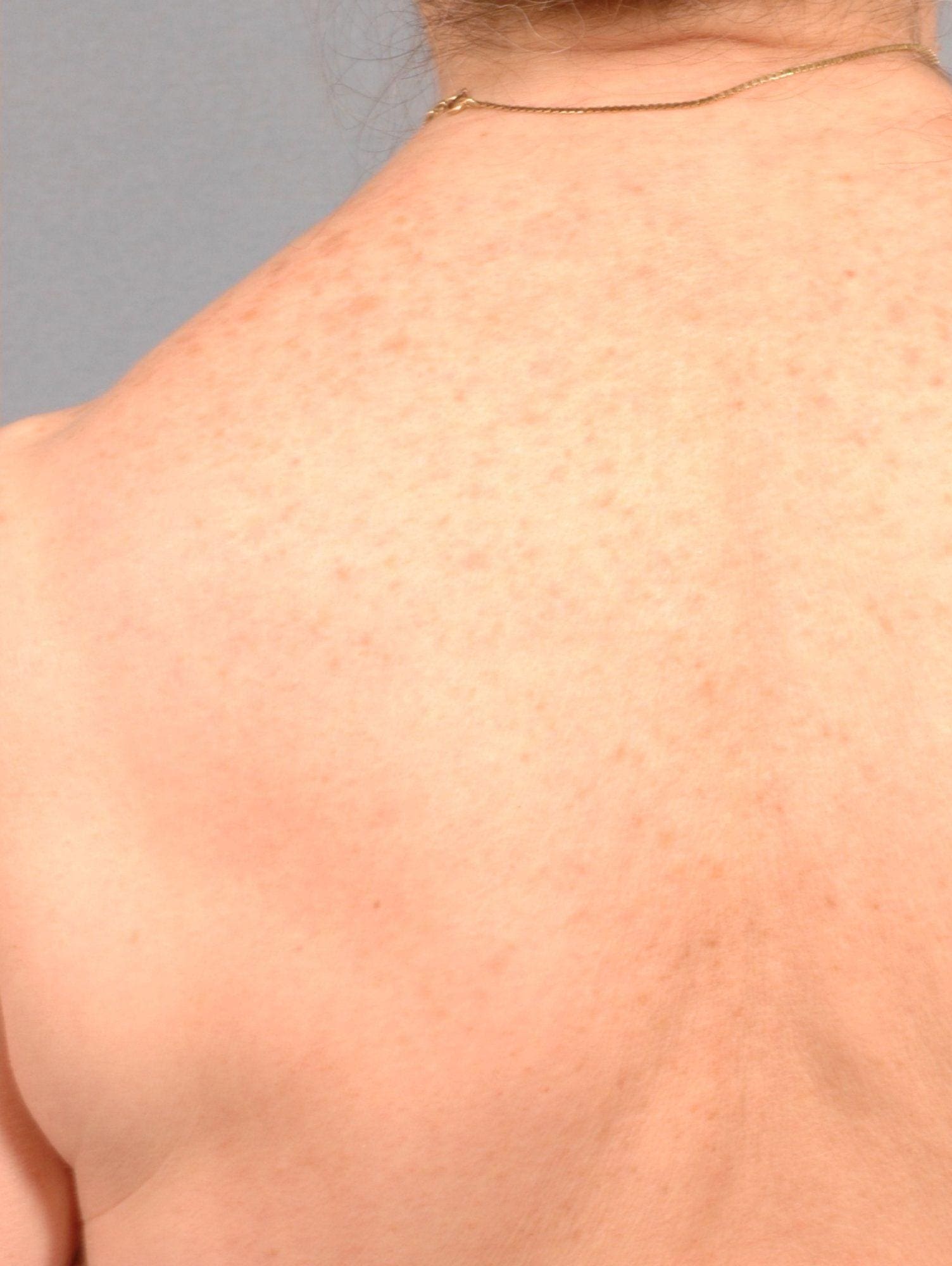 Laser Skin Treatments Patient Photo - Case 16111 - after view-1