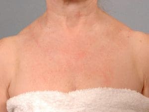Laser Skin Treatments - Case 16111 - After