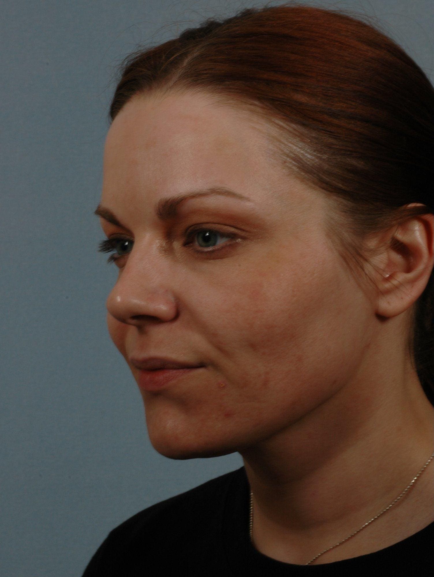 Laser Skin Treatments Patient Photo - Case 16119 - before view-1