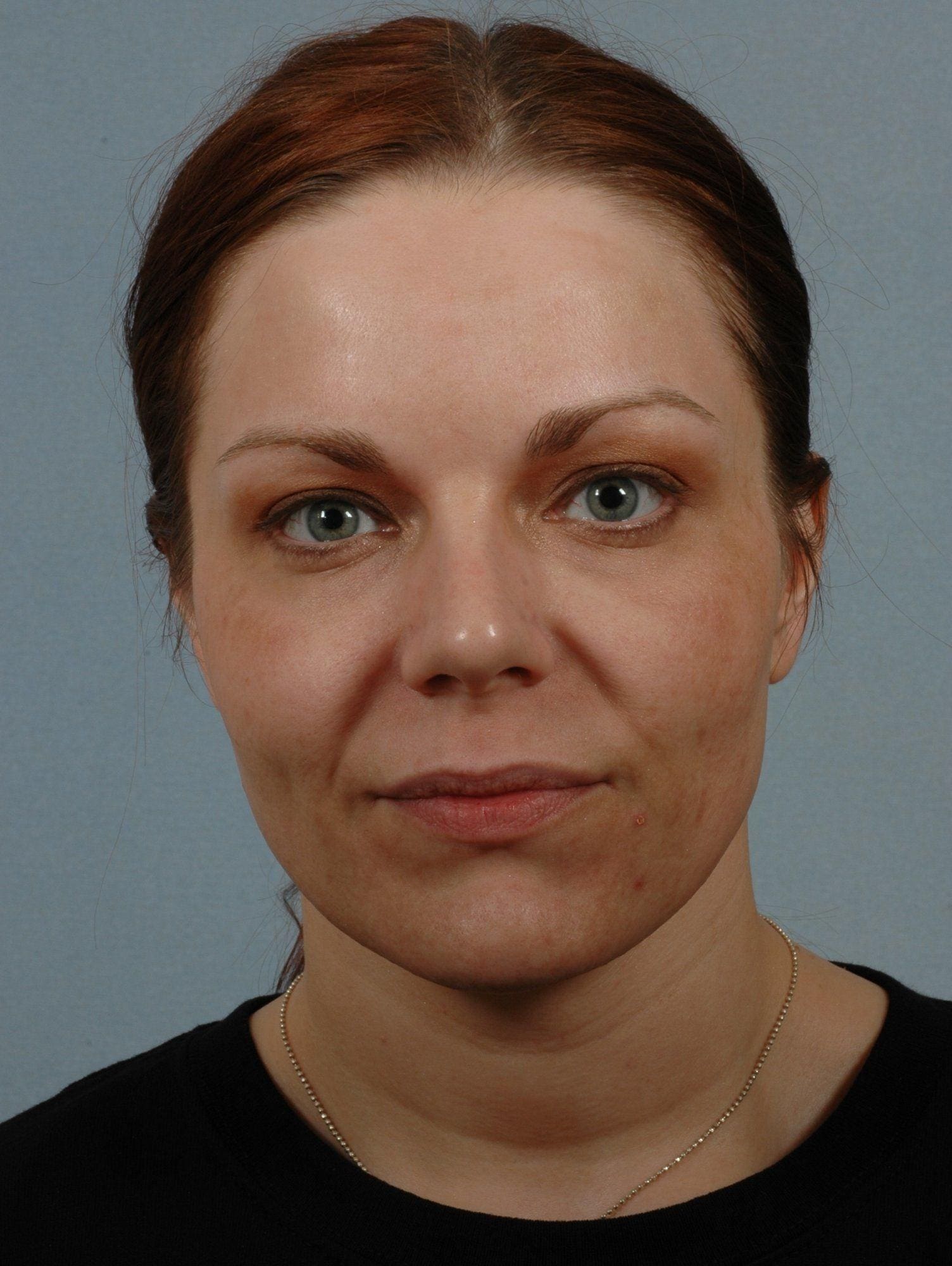 Laser Skin Treatments Patient Photo - Case 16119 - before view-