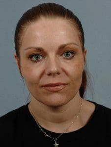 Laser Skin Treatments - Case 16119 - After