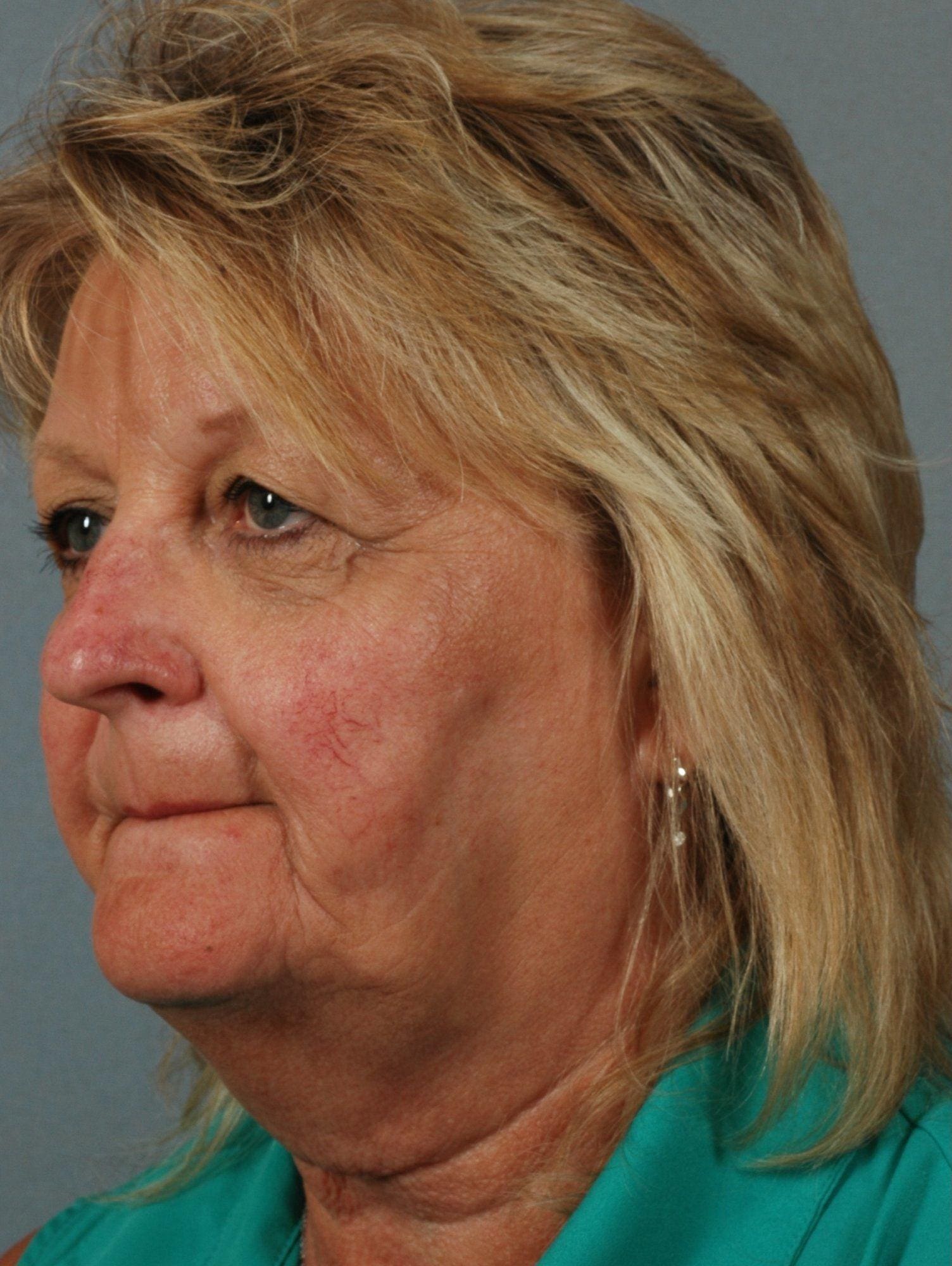 Laser Skin Treatments Patient Photo - Case 16125 - before view-1