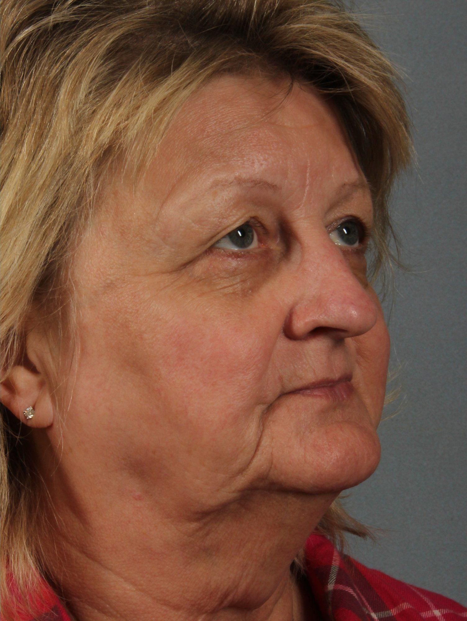 Laser Skin Treatments Patient Photo - Case 16125 - after view-2