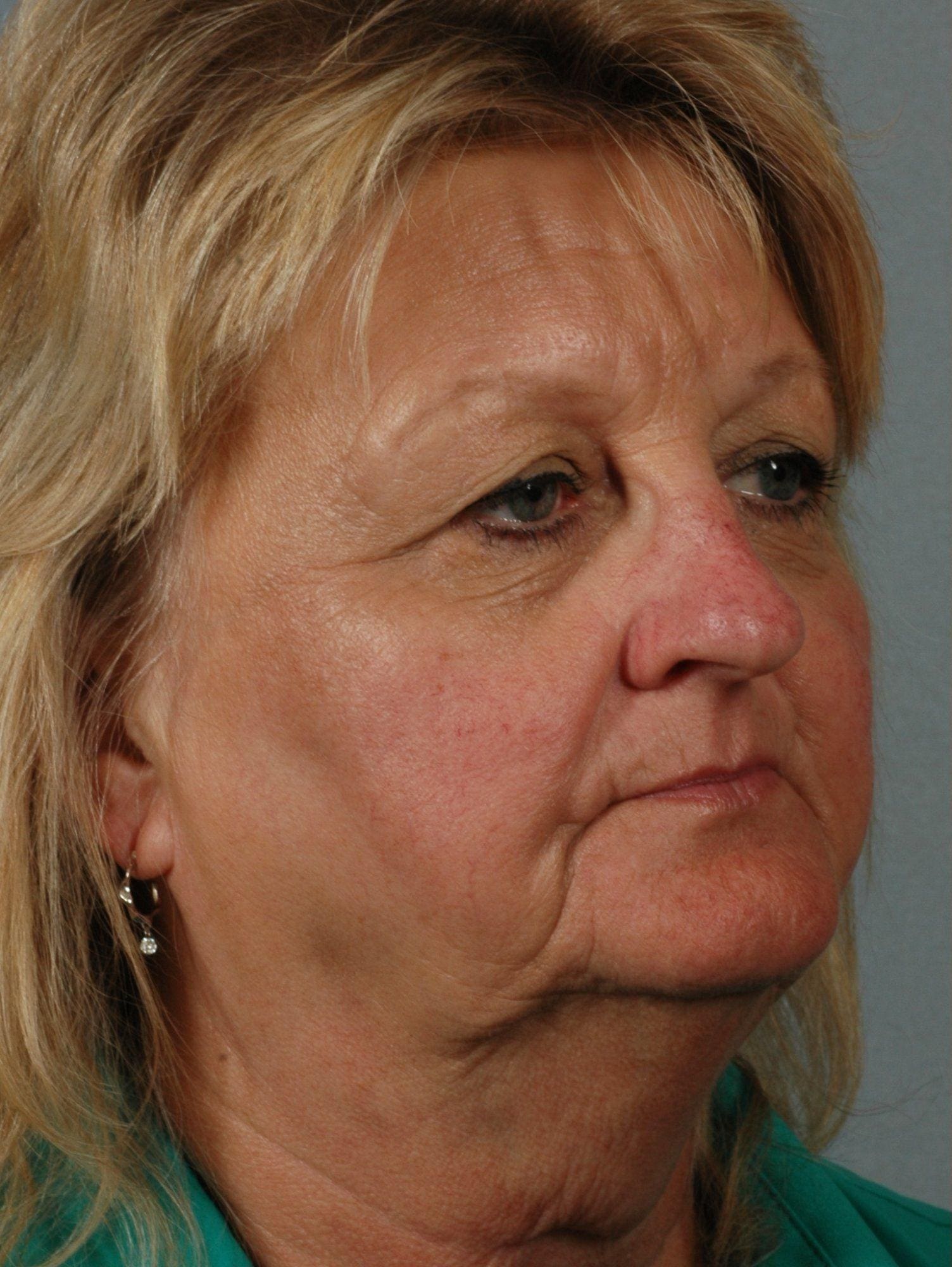 Laser Skin Treatments Patient Photo - Case 16125 - before view-2