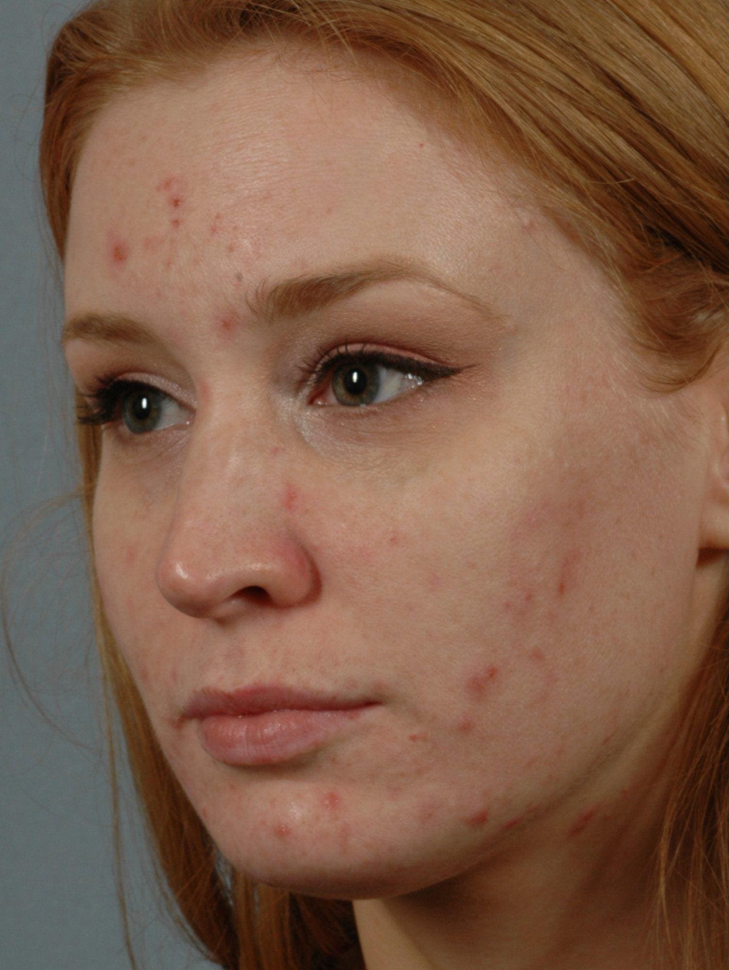 Laser Skin Treatments Patient Photo - Case 16134 - before view-1