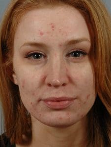 Laser Skin Treatments - Case 16134 - Before
