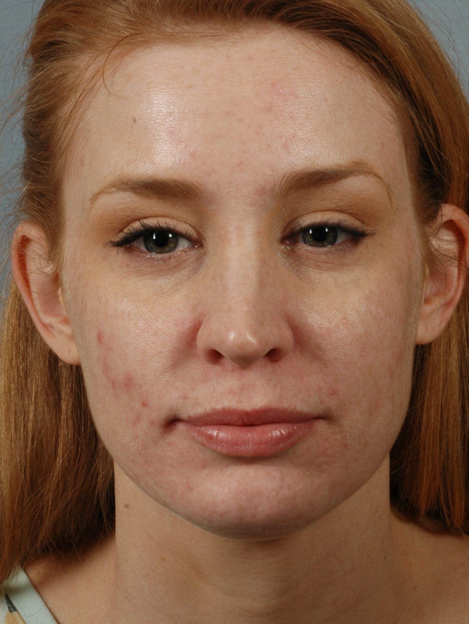 Laser Skin Treatments Patient Photo - Case 16134 - after view