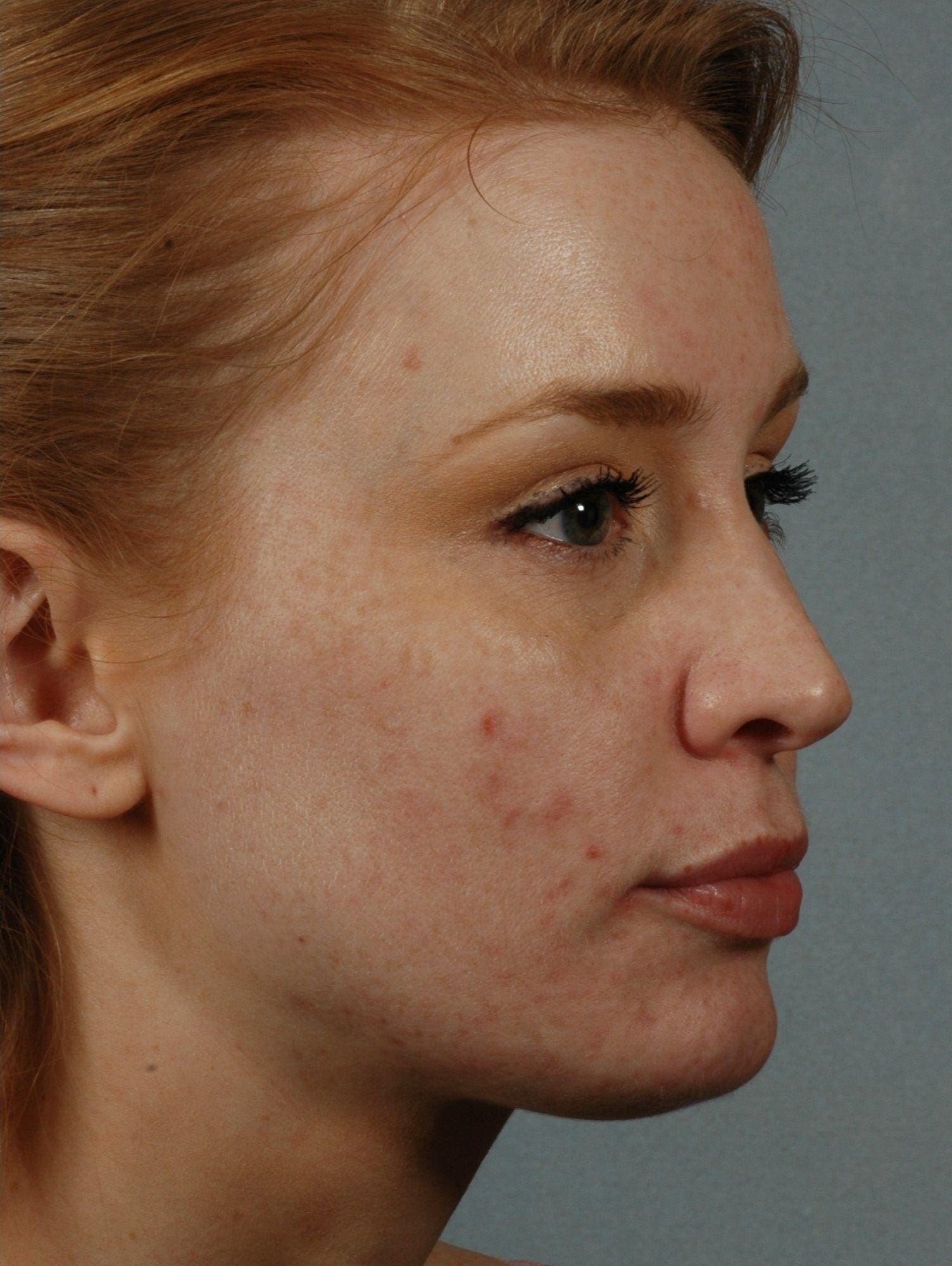 Laser Skin Treatments Patient Photo - Case 16134 - after view-2