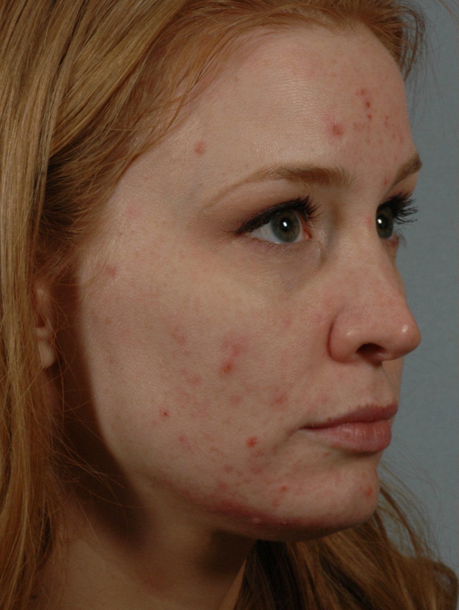 Laser Skin Treatments Patient Photo - Case 16134 - before view-2