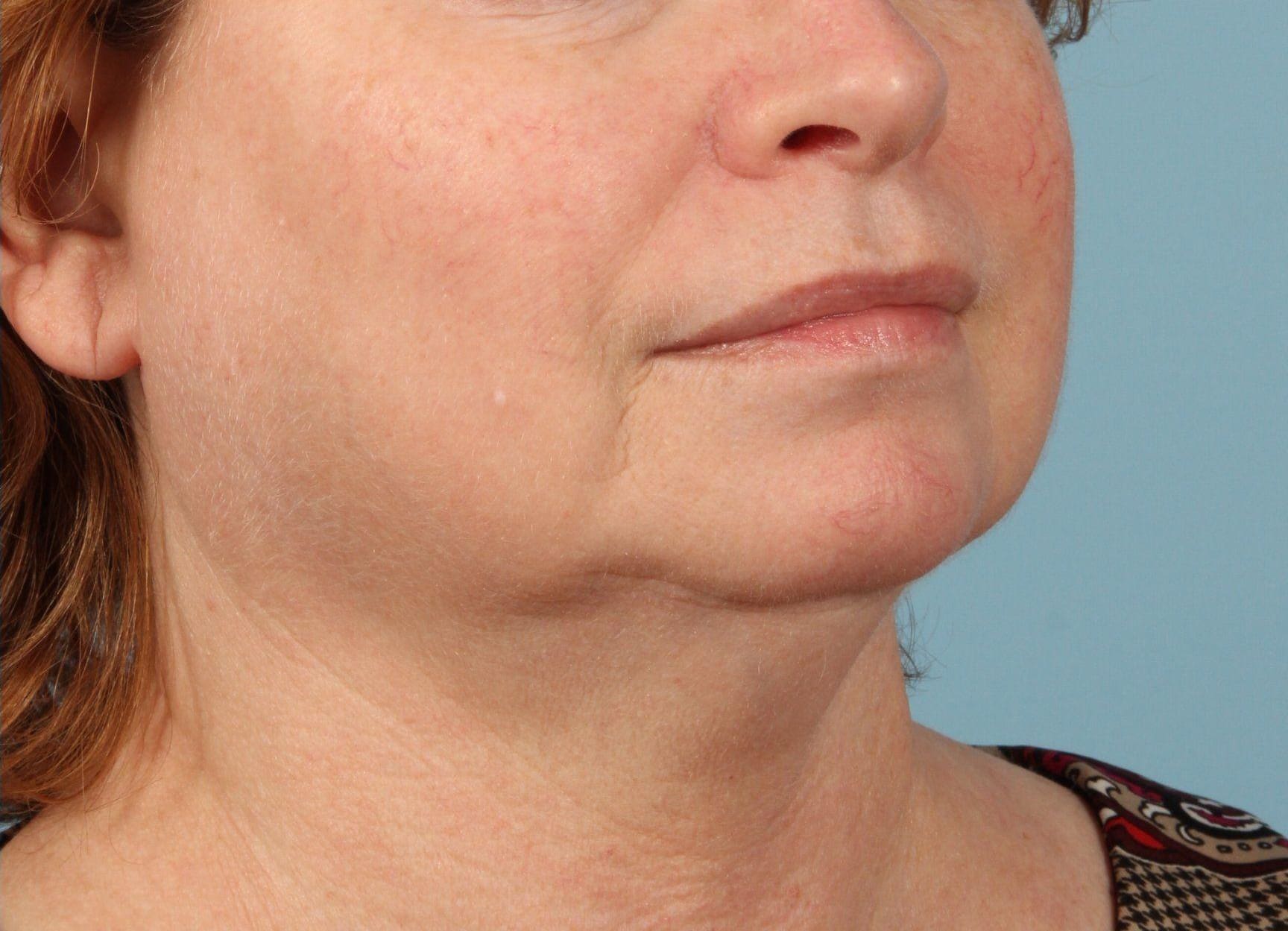 Laser Skin Treatments Patient Photo - Case 16142 - after view-3