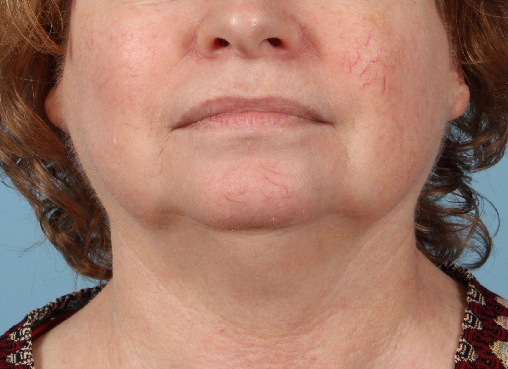 Laser Skin Treatments Patient Photo - Case 16142 - before view-