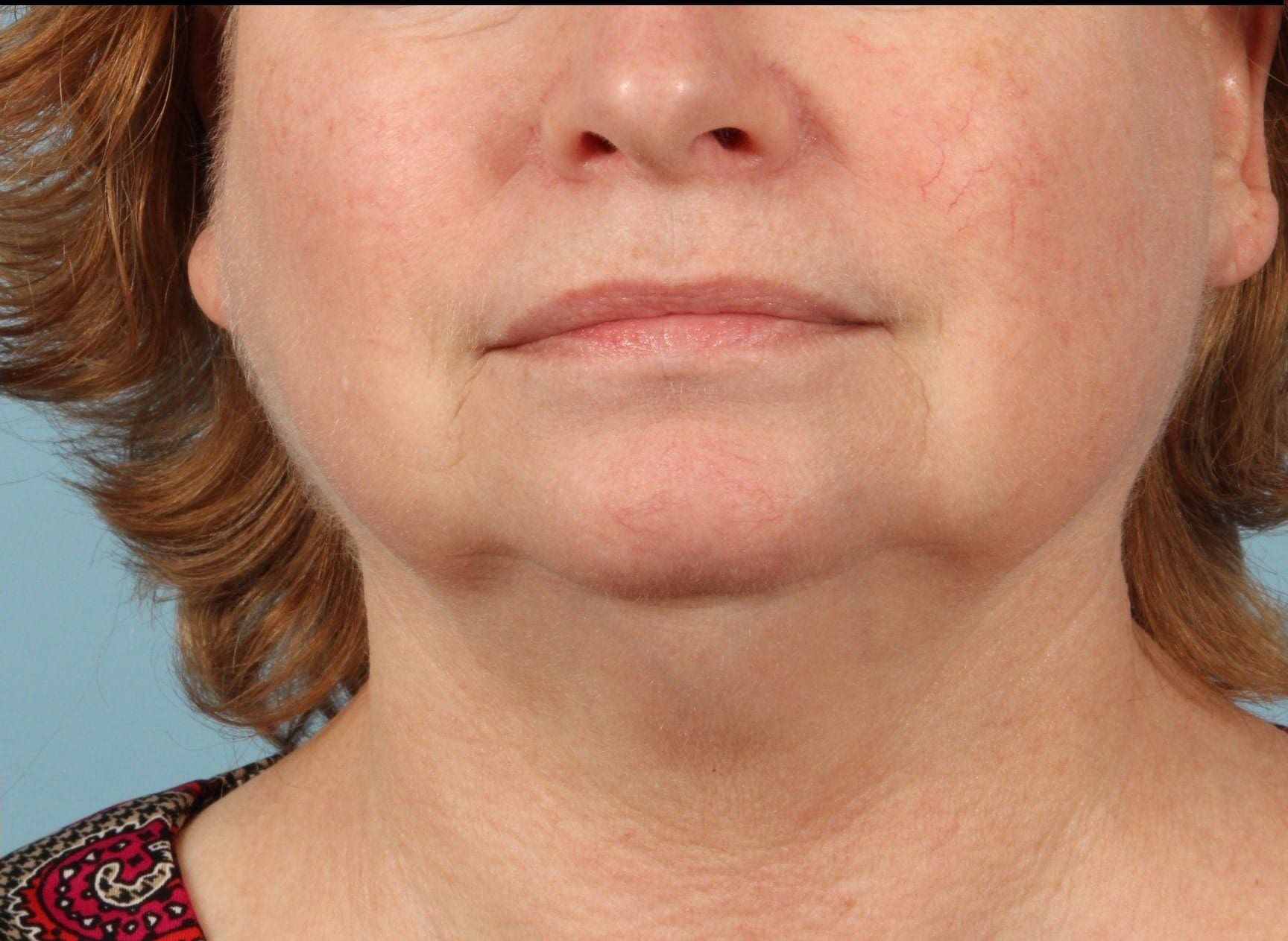 Laser Skin Treatments Patient Photo - Case 16142 - after view