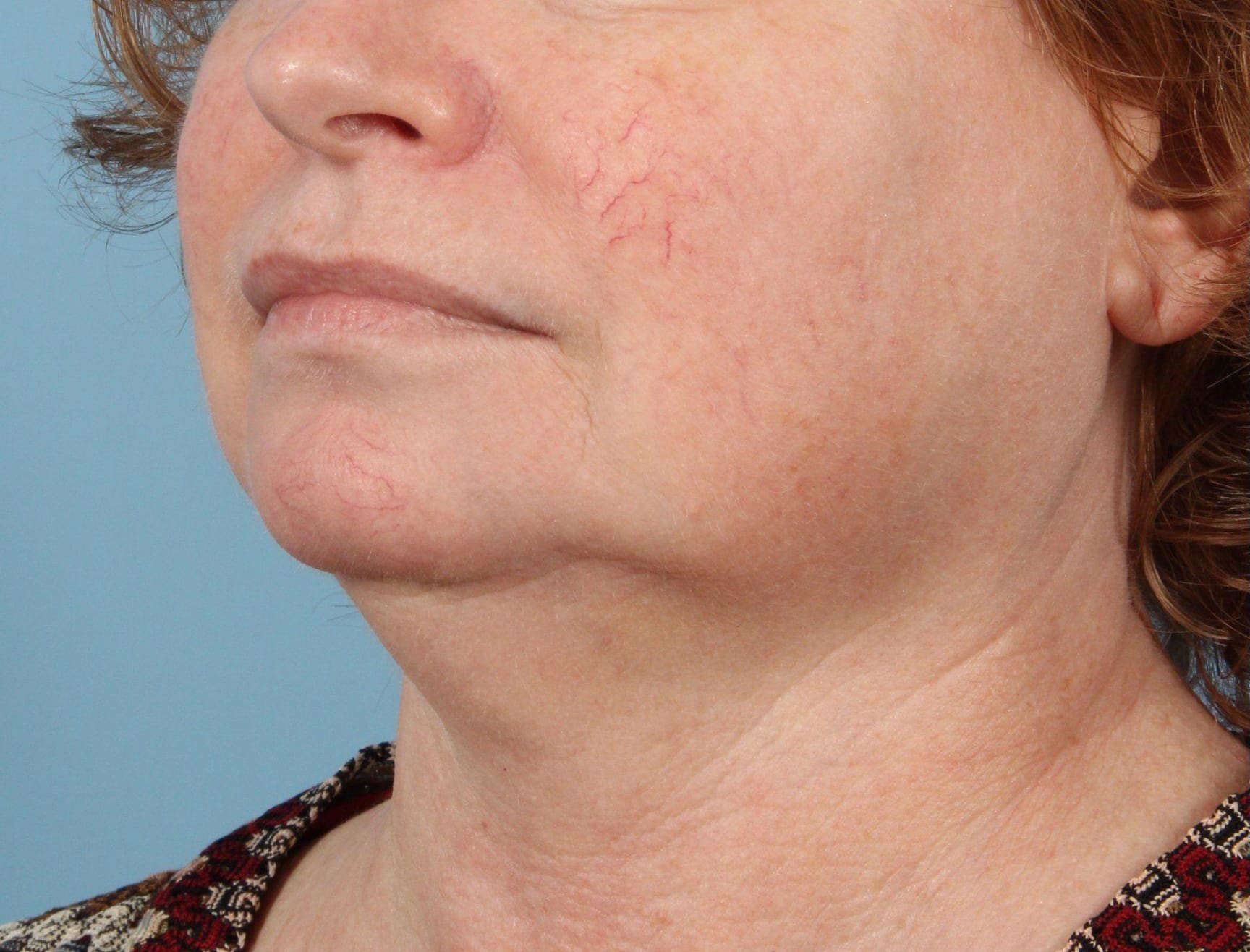 Laser Skin Treatments Patient Photo - Case 16142 - before view-2