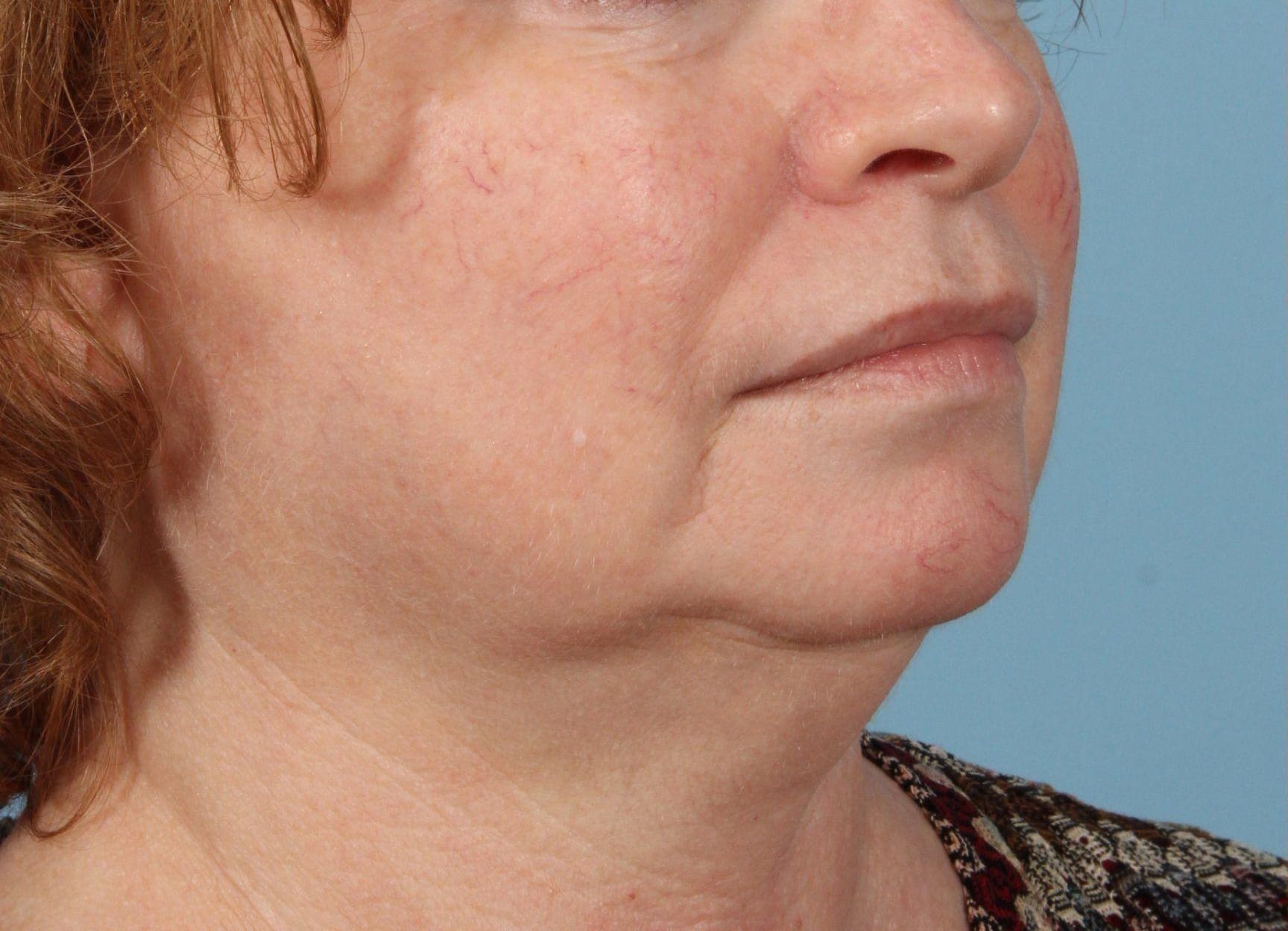 Laser Skin Treatments Patient Photo - Case 16142 - before view-3