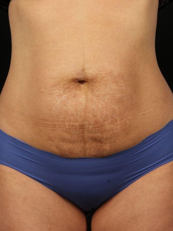 Laser Skin Treatments Patient Photo - Case 16152 - before view-
