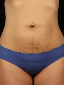 Laser Skin Treatments - Case 16152 - After