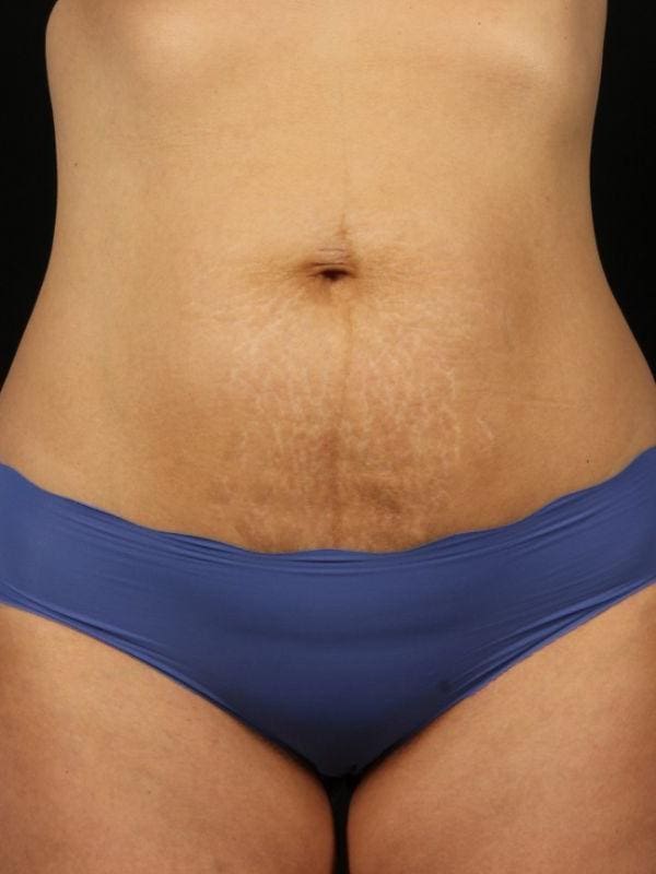 Laser Skin Treatments Patient Photo - Case 16152 - after view