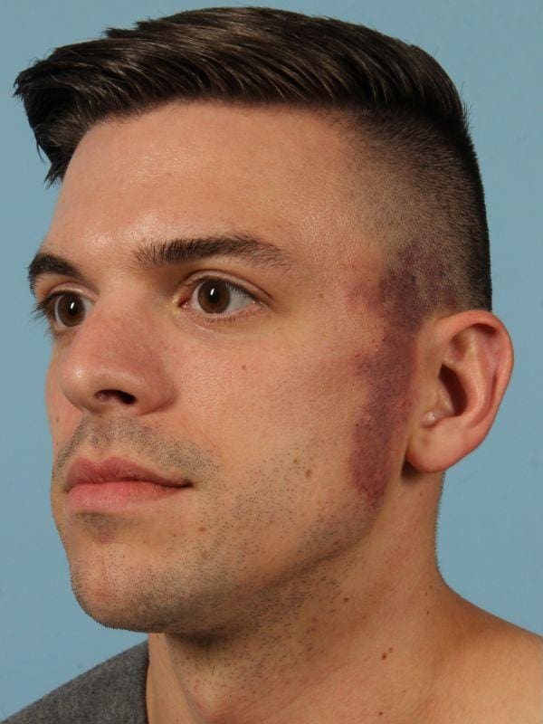 Laser Skin Treatments Patient Photo - Case 16156 - before view-1