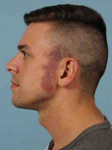 Laser Skin Treatments - Case 16156 - Before