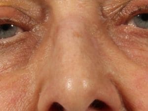 Laser Skin Treatments - Case 16162 - After