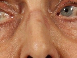 Laser Skin Treatments - Case 16162 - Before