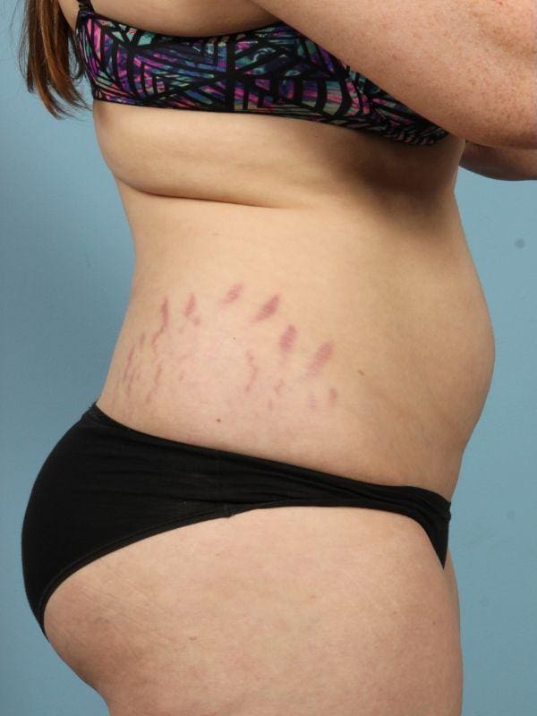 Laser Skin Treatments Patient Photo - Case 16169 - before view-1