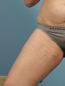 Laser Skin Treatments - Case 16169 - After