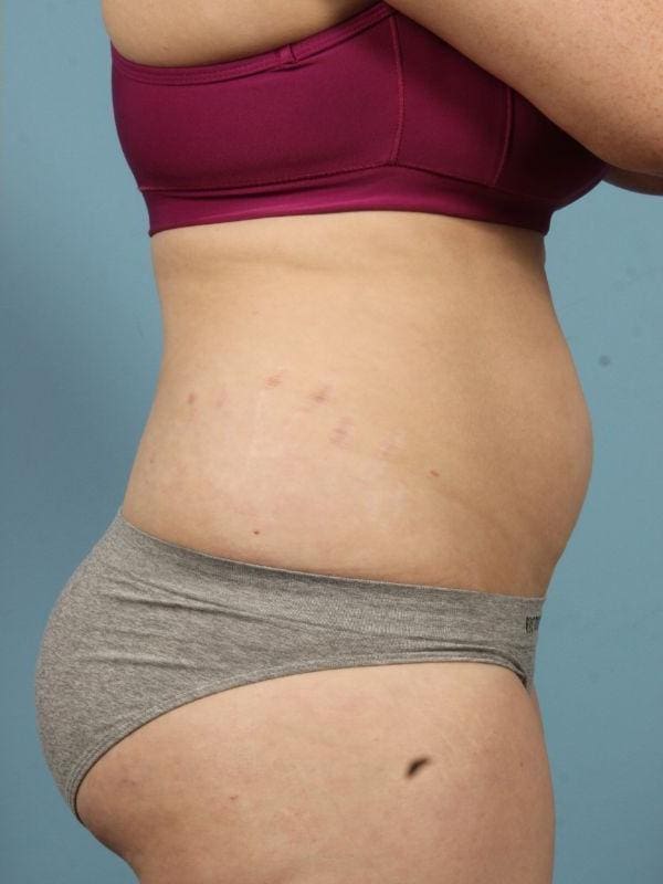 Laser Skin Treatments Patient Photo - Case 16169 - after view-1