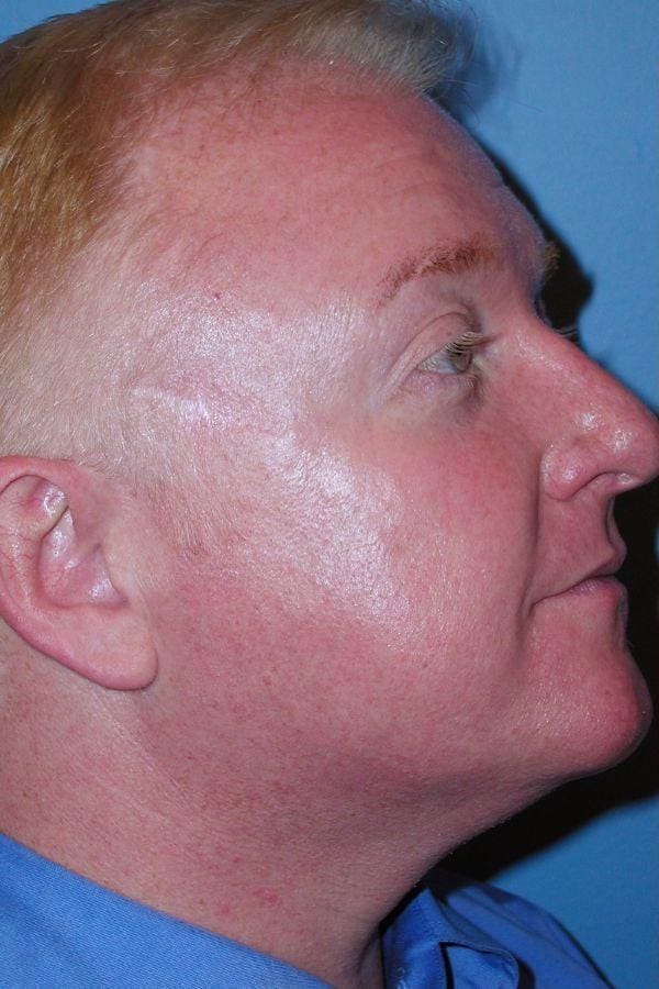 Laser Skin Treatments Patient Photo - Case 16176 - before view-1