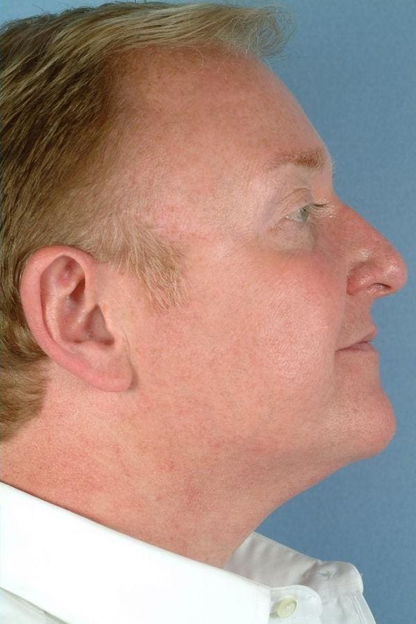 Laser Skin Treatments Patient Photo - Case 16176 - after view-1
