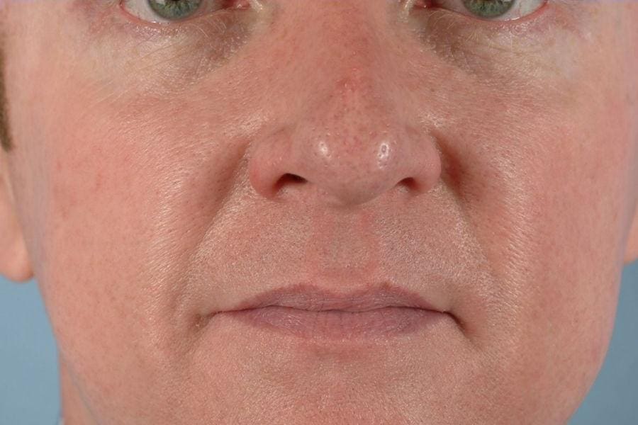 Laser Skin Treatments Patient Photo - Case 16176 - after view-2