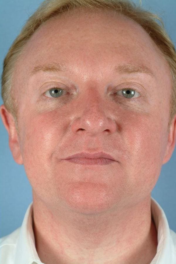 Laser Skin Treatments Patient Photo - Case 16176 - after view