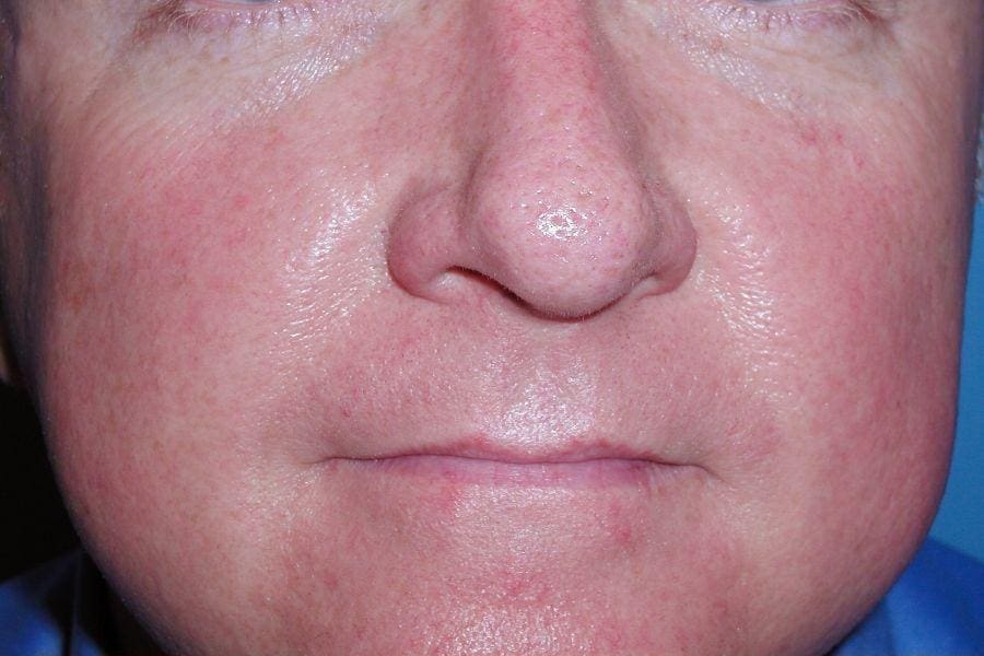 Laser Skin Treatments Patient Photo - Case 16176 - before view-2