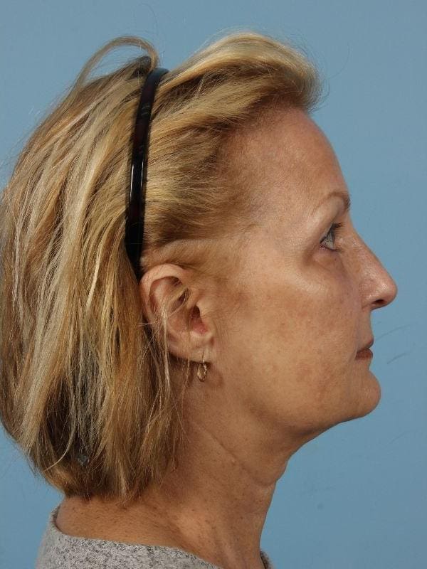 Laser Skin Treatments Patient Photo - Case 16185 - after view-3