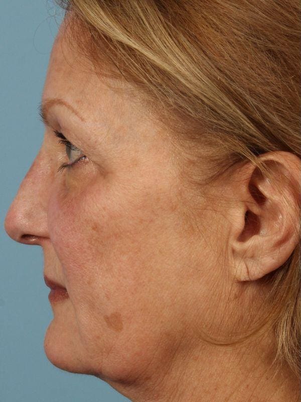 Laser Skin Treatments Patient Photo - Case 16185 - before view-2