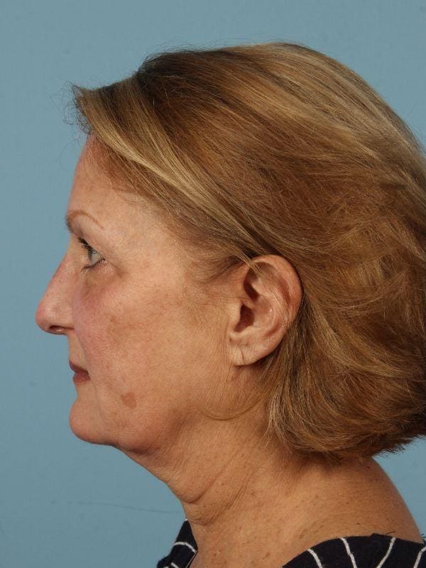 Laser Skin Treatments Patient Photo - Case 16185 - before view-1