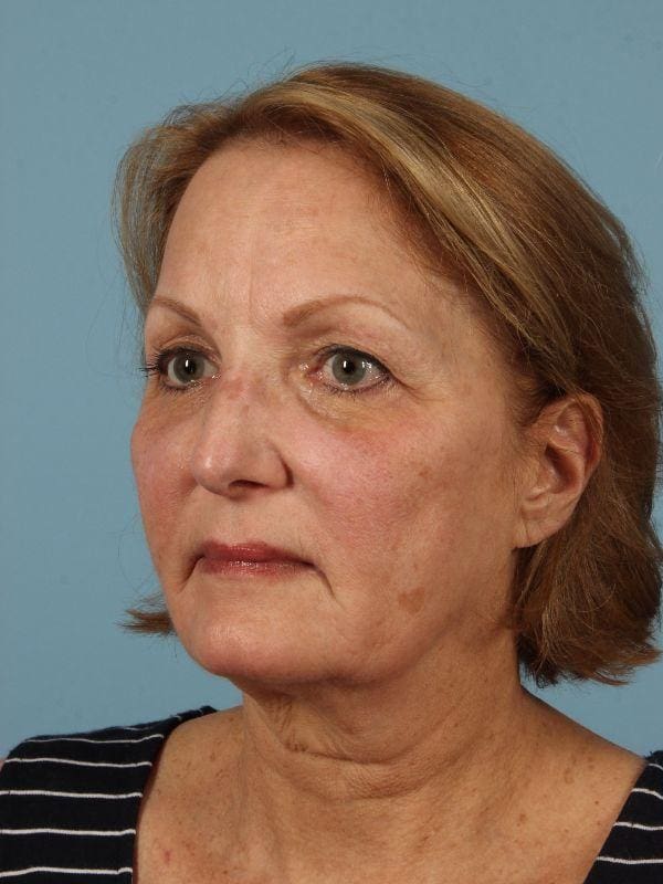 Laser Skin Treatments Patient Photo - Case 16185 - before view-5