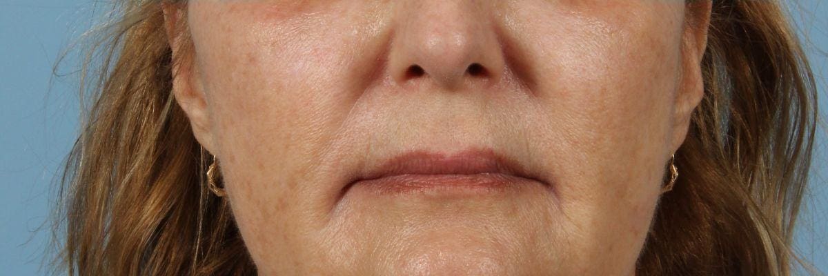 Laser Skin Treatments Patient Photo - Case 16185 - after view-7