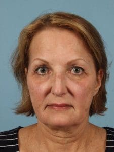 Laser Skin Treatments - Case 16185 - Before