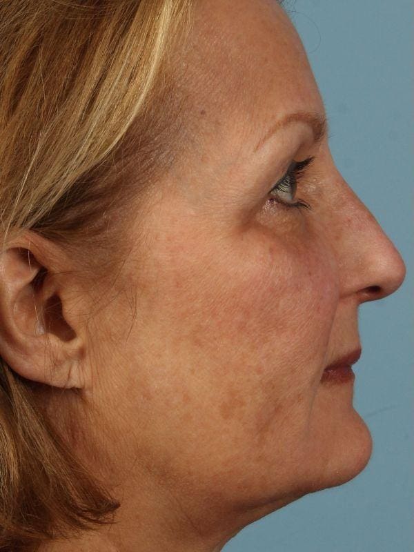 Laser Skin Treatments Patient Photo - Case 16185 - before view-4