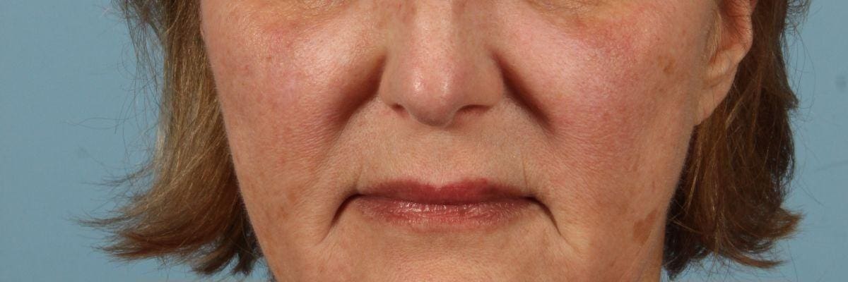 Laser Skin Treatments Patient Photo - Case 16185 - before view-7