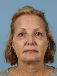 Laser Skin Treatments - Case 16185 - After